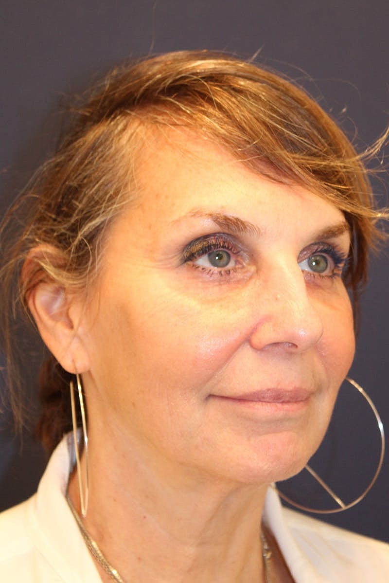 Sofwave Before & After