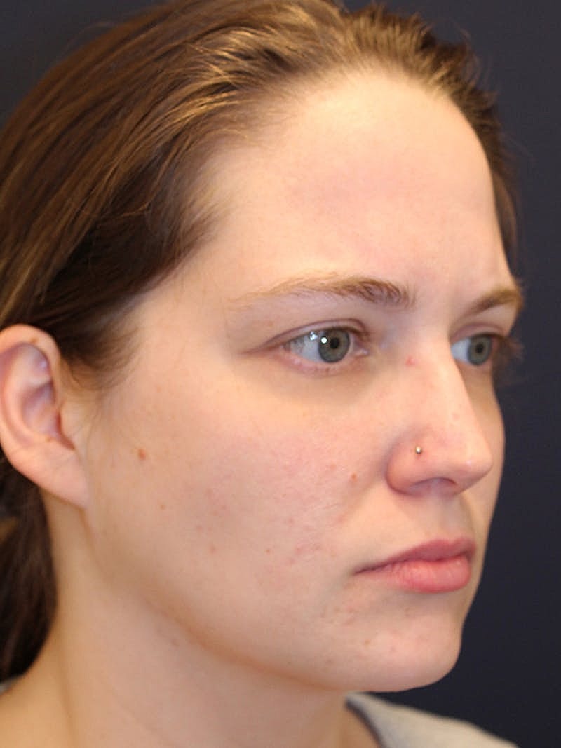 Sofwave Before & After