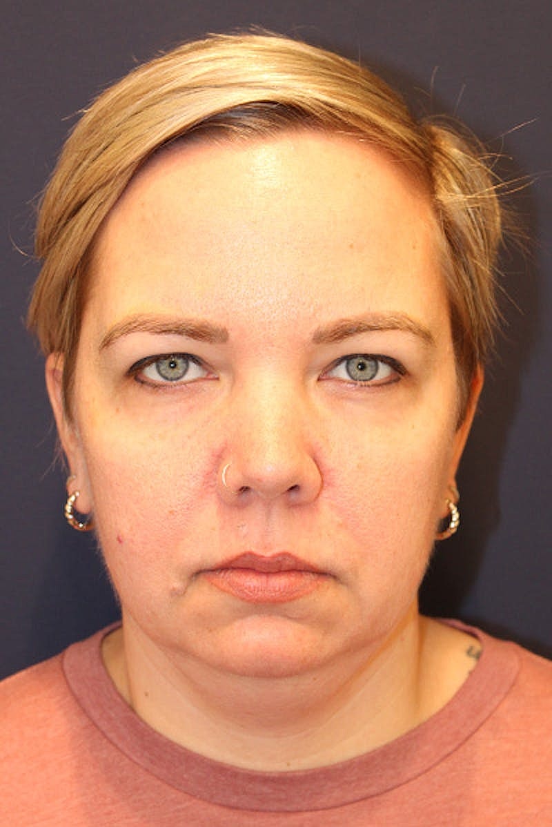 Sofwave Before & After