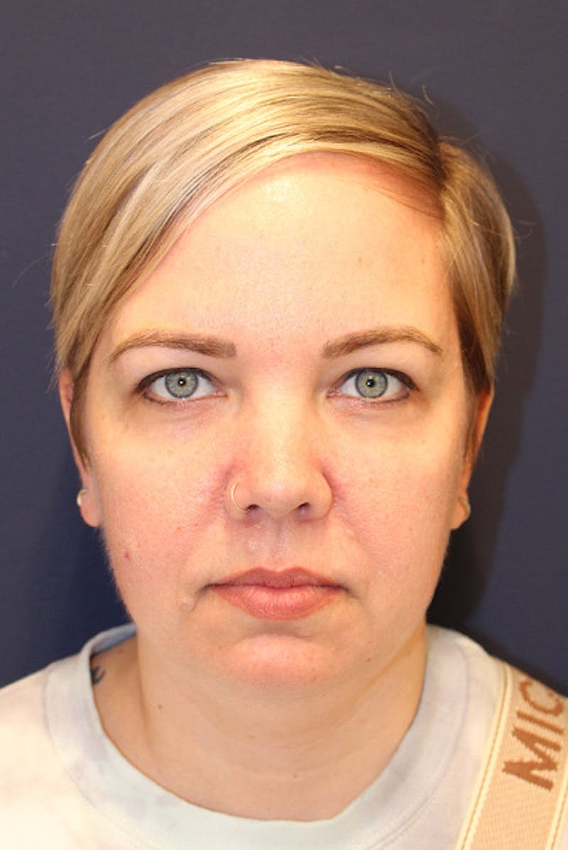 Sofwave Before & After