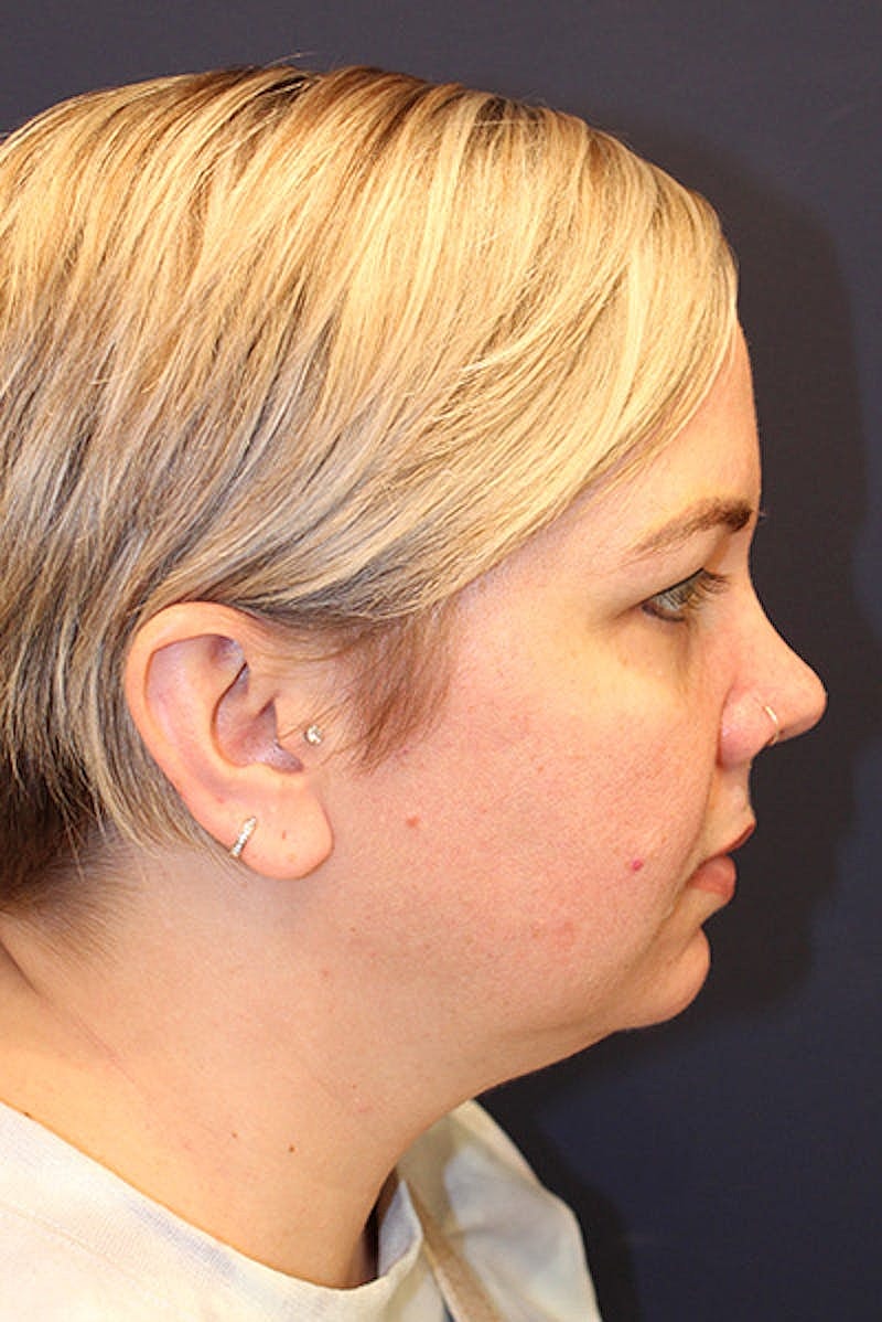 Sofwave Before & After