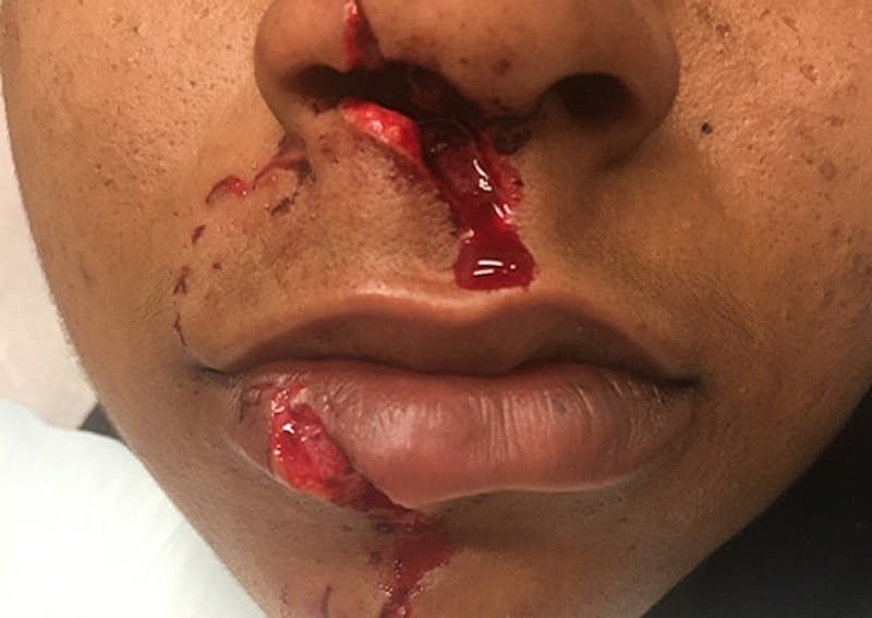 Complex Facial Reconstruction Cancer Trauma Before & After