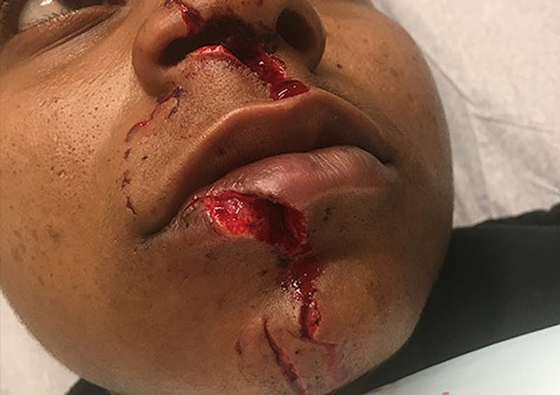 Complex Facial Reconstruction Cancer Trauma Before & After