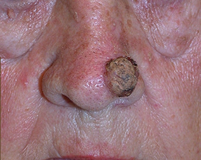 Complex Facial Reconstruction Cancer Trauma Before & After