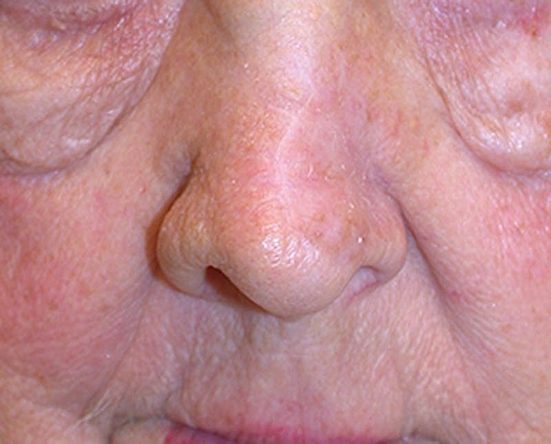 Complex Facial Reconstruction Cancer Trauma Before & After