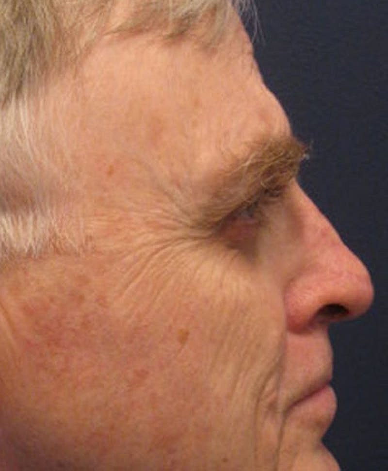 Complex Facial Reconstruction Cancer Trauma Before & After