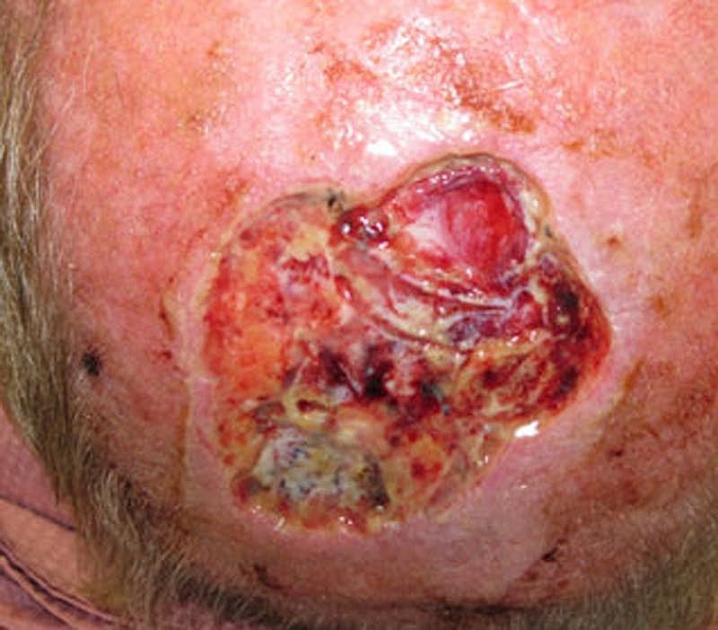Complex Facial Reconstruction Cancer Trauma Before & After