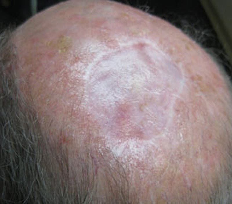 Complex Facial Reconstruction Cancer Trauma Before & After