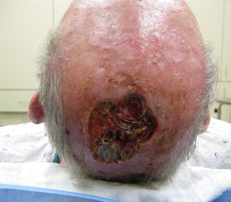 Complex Facial Reconstruction Cancer Trauma Before & After
