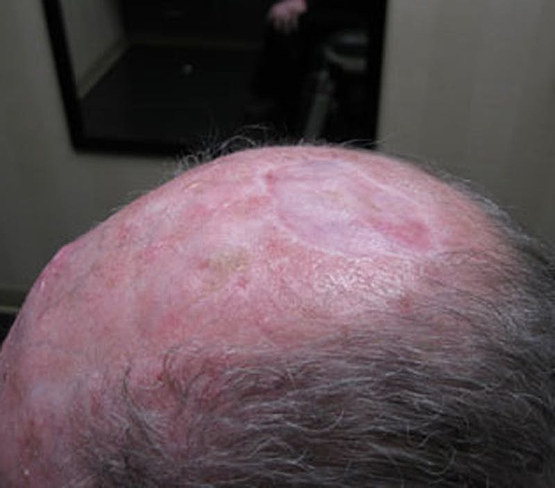 Complex Facial Reconstruction Cancer Trauma Before & After