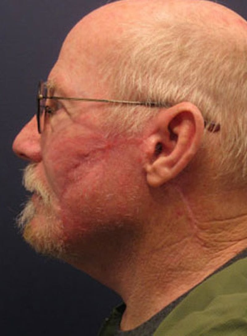 Complex Facial Reconstruction Cancer Trauma Before & After