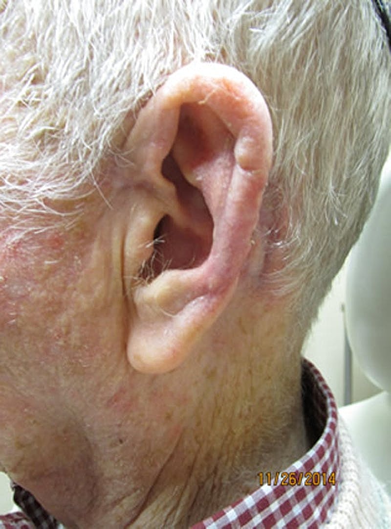 Complex Facial Reconstruction Cancer Trauma Before & After