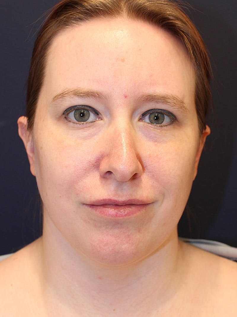 Neck Liposuction Before & After