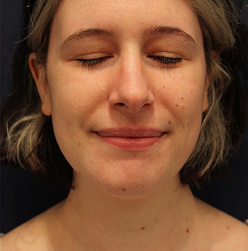 Neck Liposuction Before & After