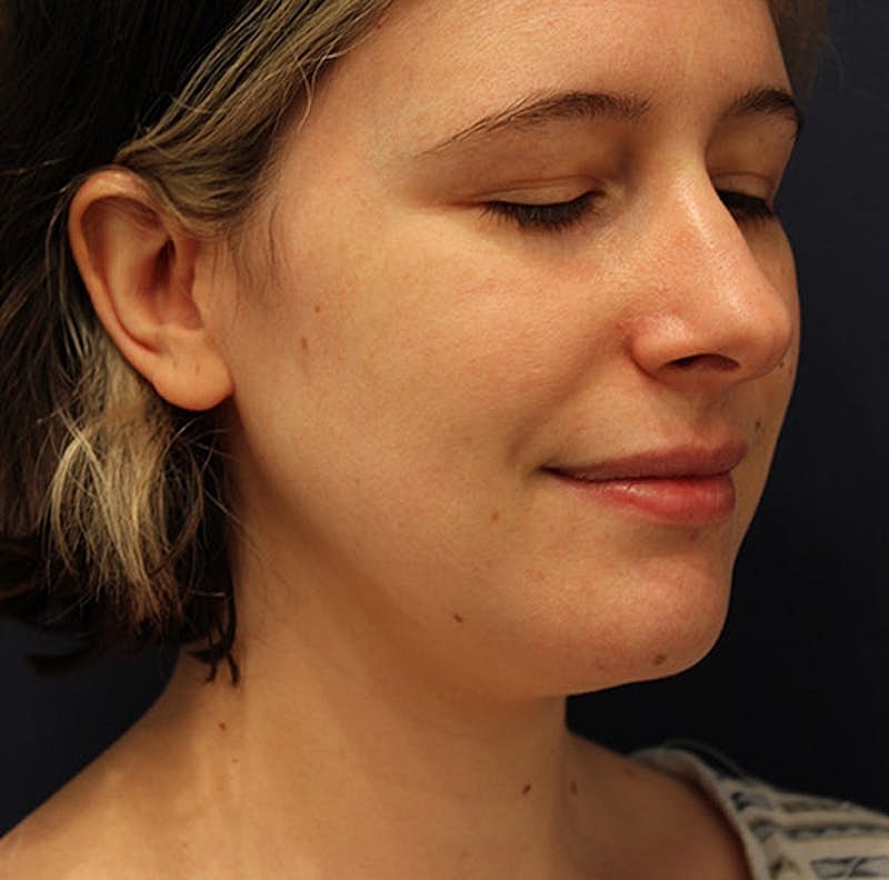 Neck Liposuction Before & After