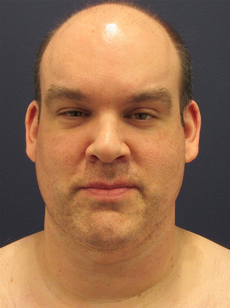 Neck Liposuction Before & After