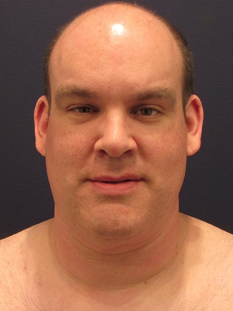 Neck Liposuction Before & After