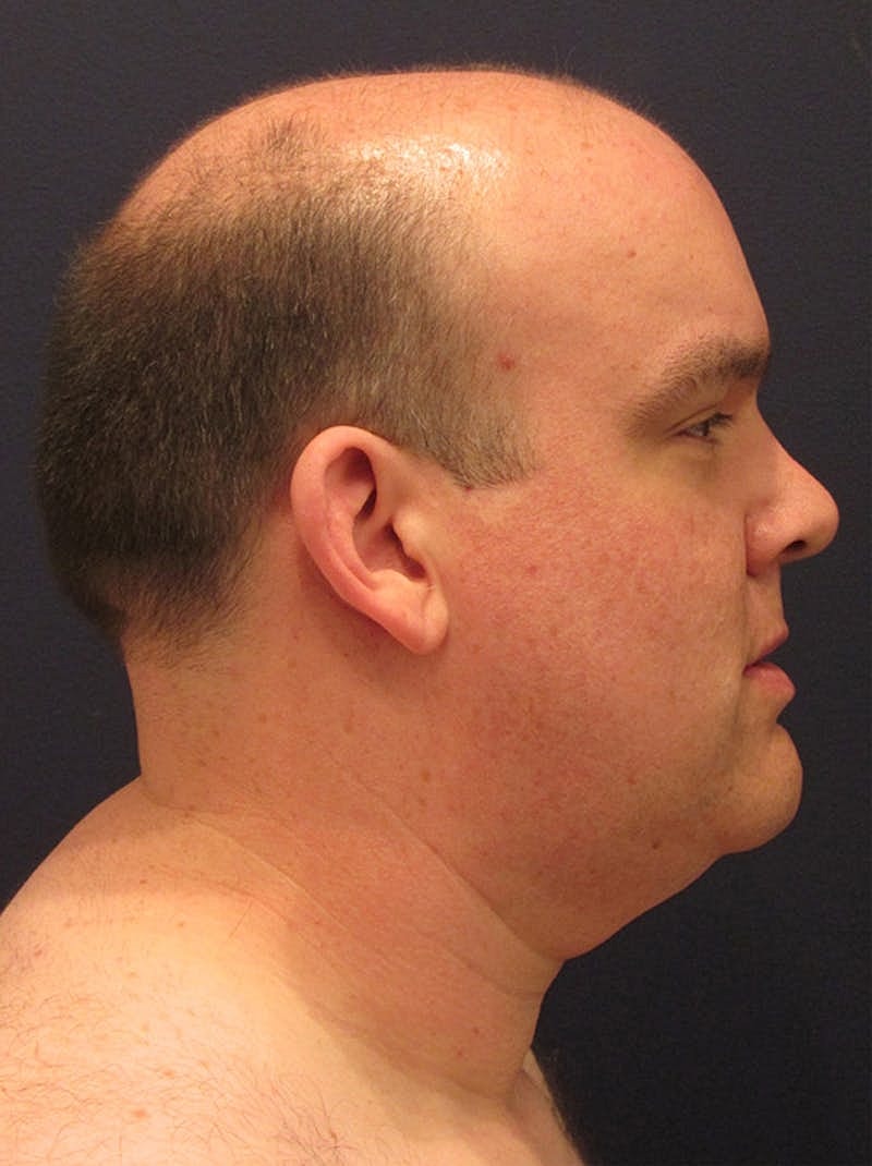 Neck Liposuction Before & After