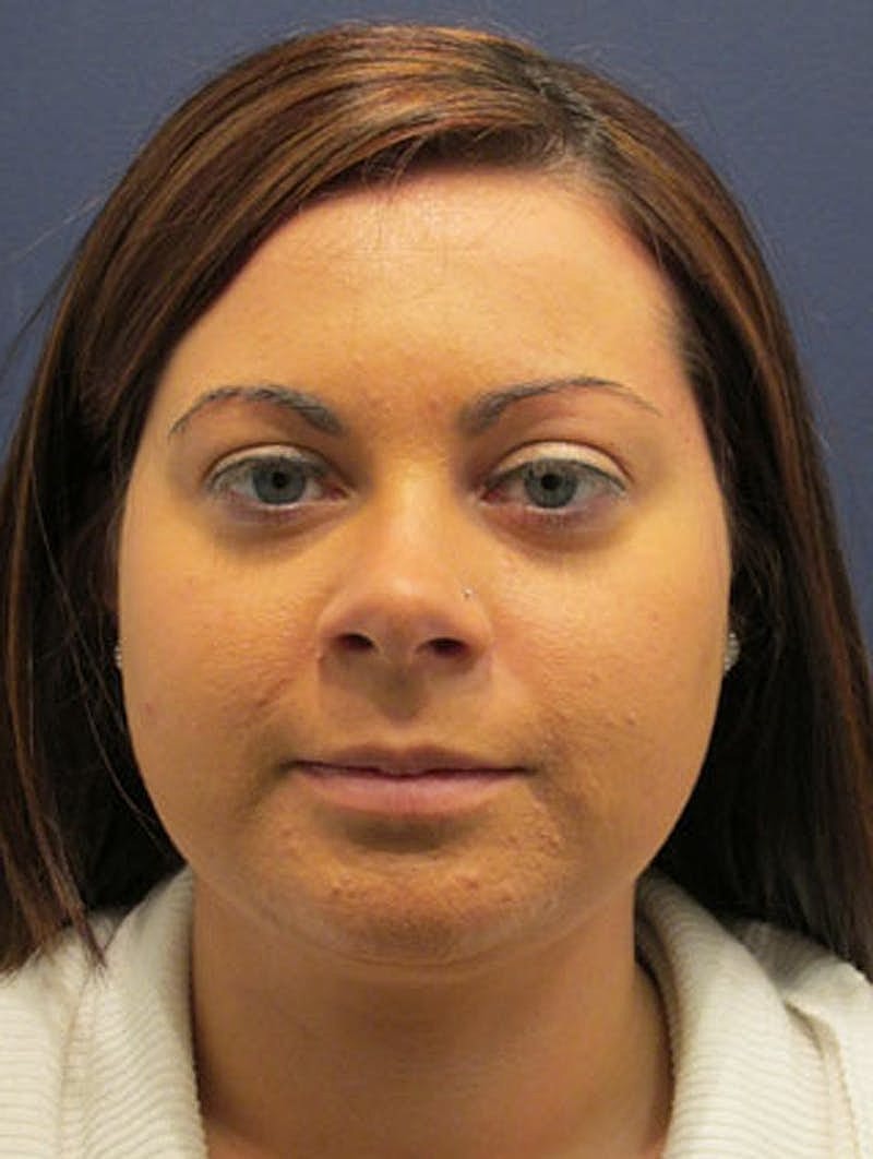 Neck Liposuction Before & After