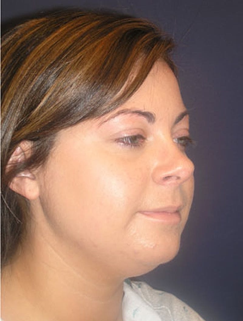 Neck Liposuction Before & After