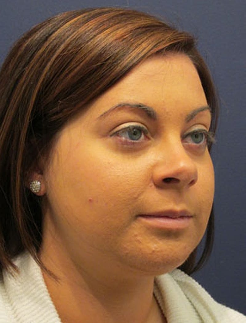 Neck Liposuction Before & After