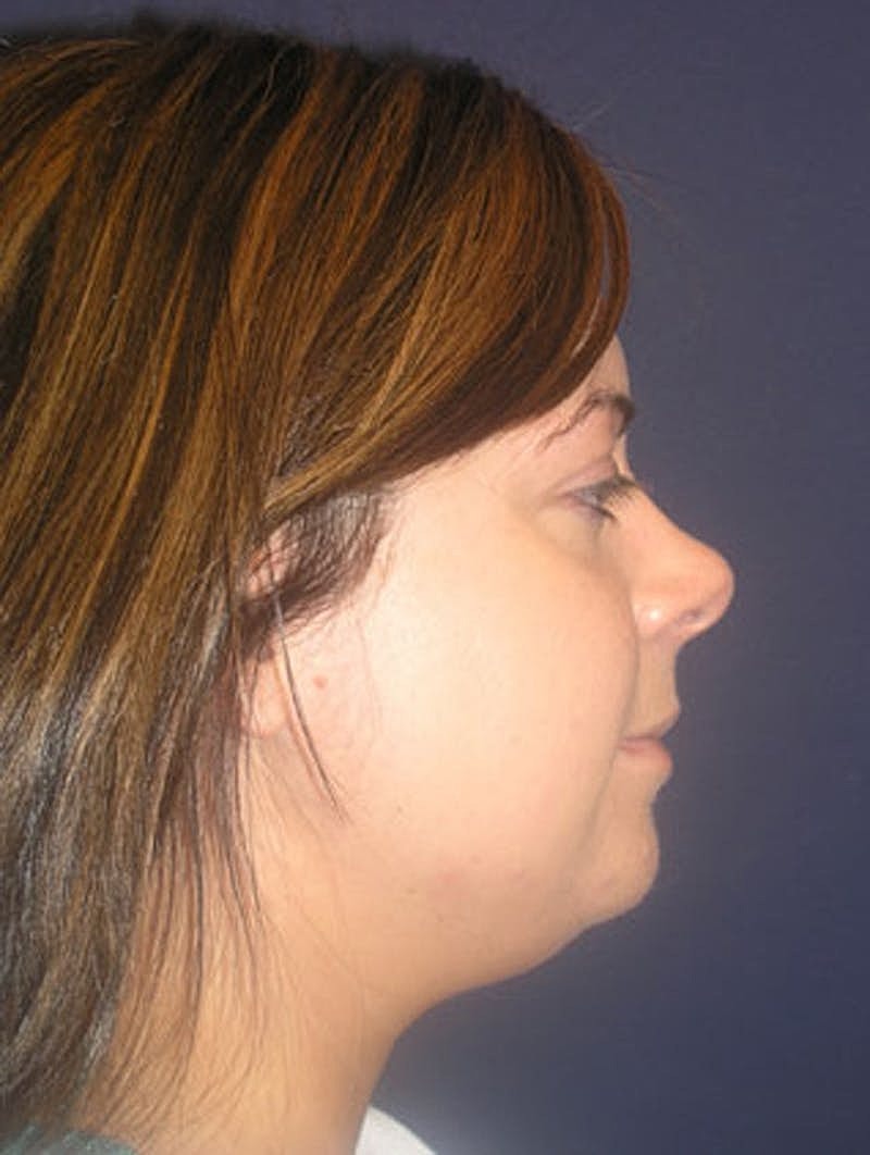 Neck Liposuction Before & After
