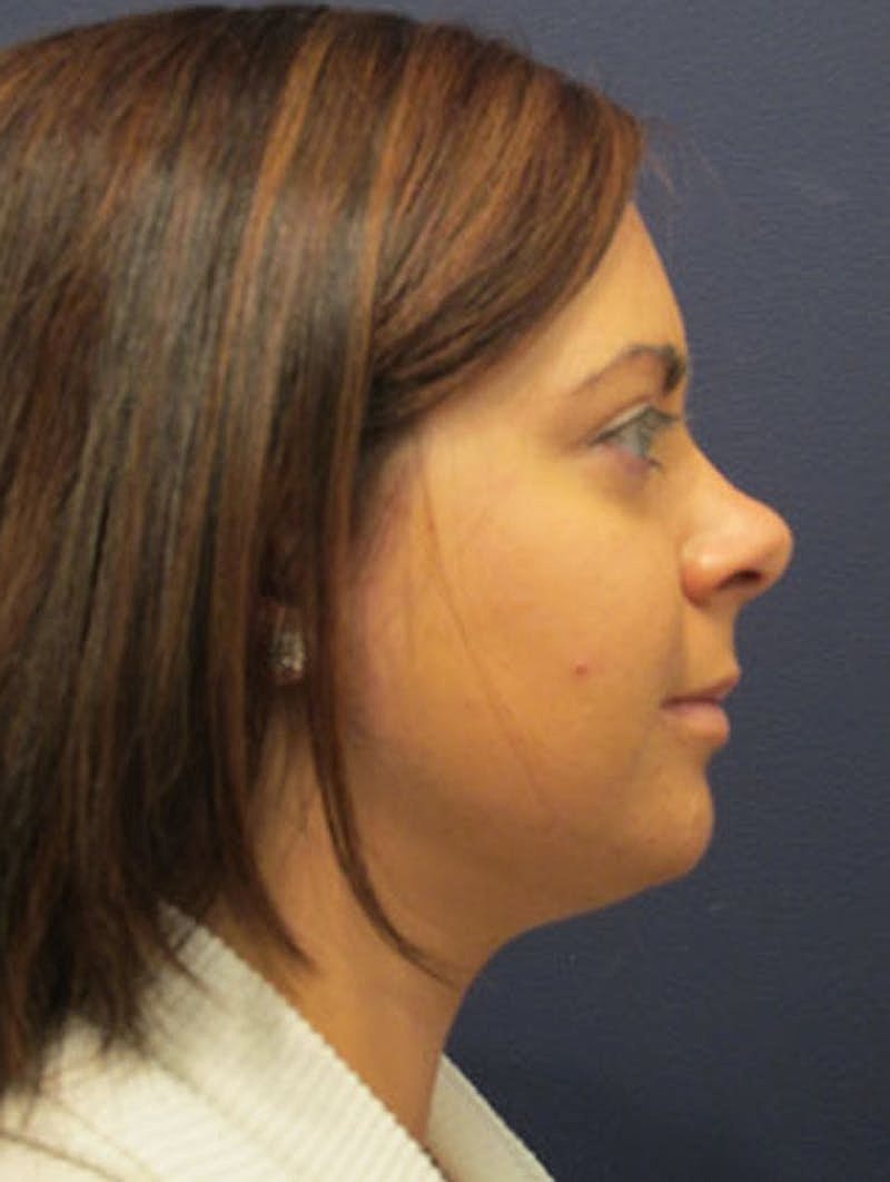 Neck Liposuction Before & After