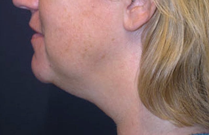 Neck Liposuction Before & After