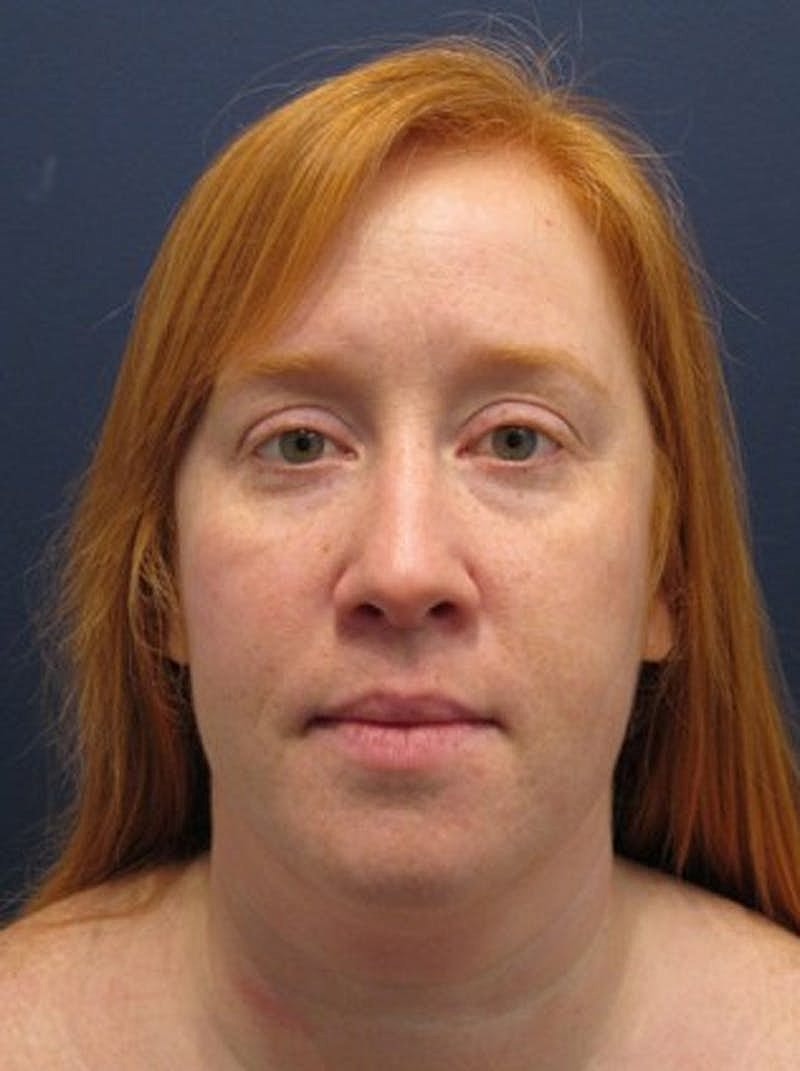 Neck Liposuction Before & After