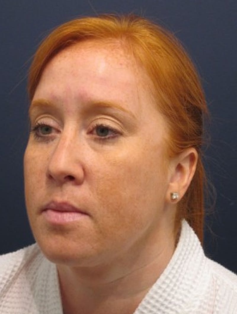 Neck Liposuction Before & After