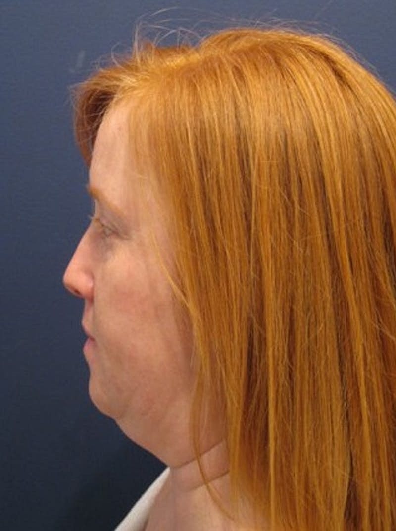 Neck Liposuction Before & After