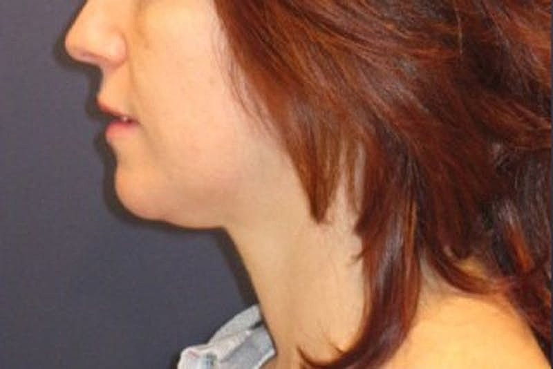 Neck Liposuction Before & After