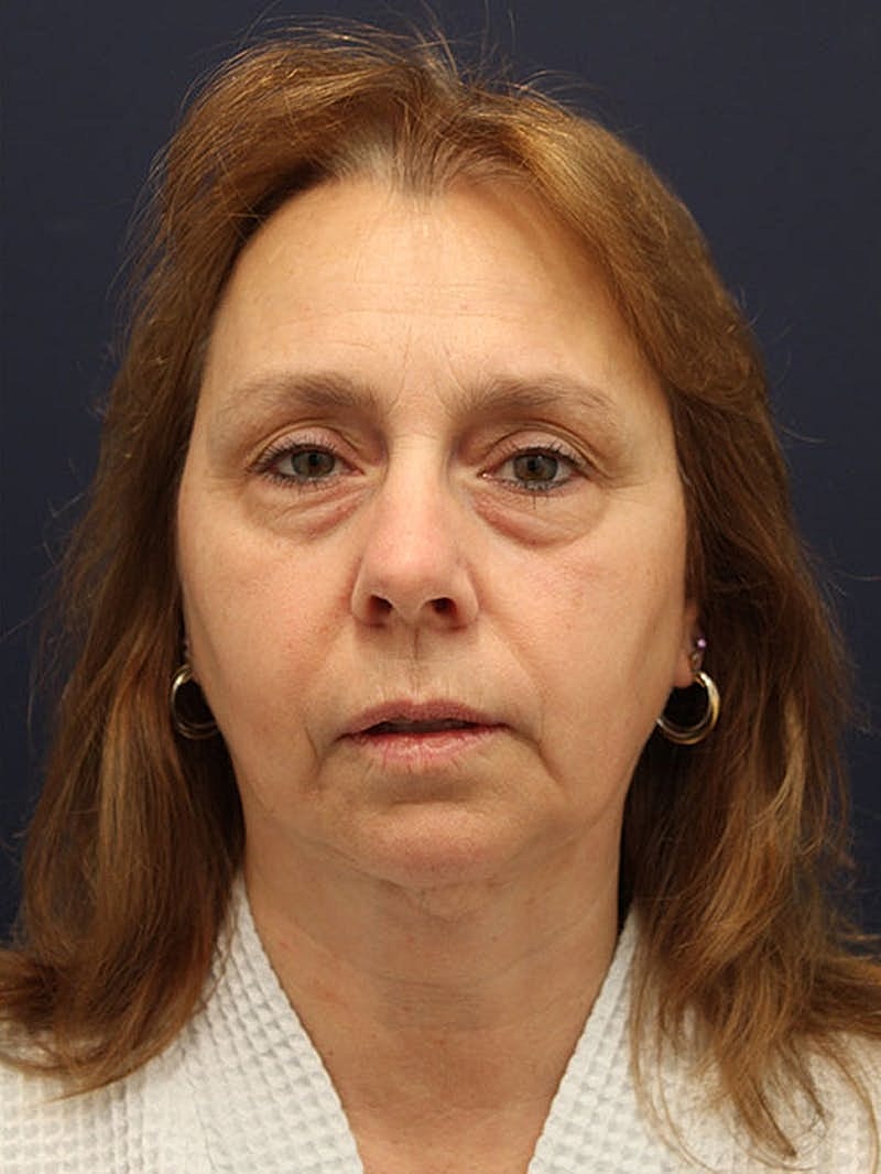 Neck Liposuction Before & After