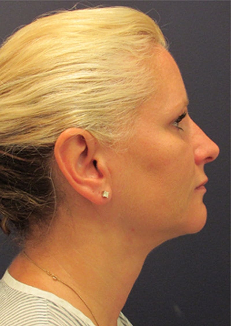 Neck Liposuction Before & After