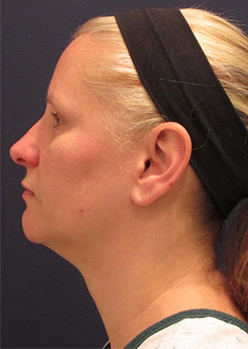 Neck Liposuction Before & After