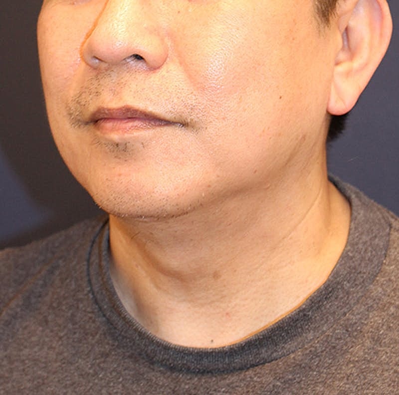 Neck Liposuction Before & After