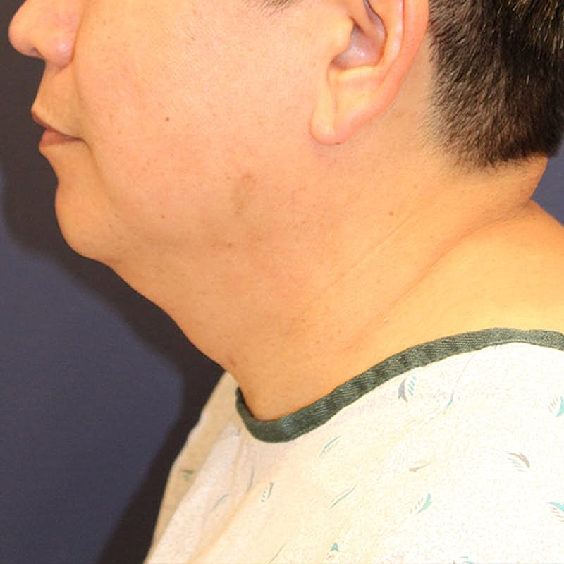 Neck Liposuction Before & After