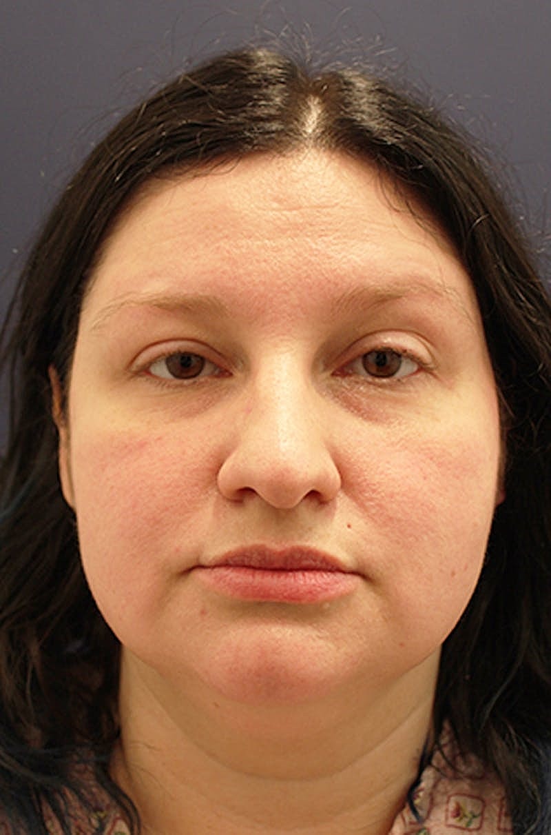 Neck Liposuction Before & After