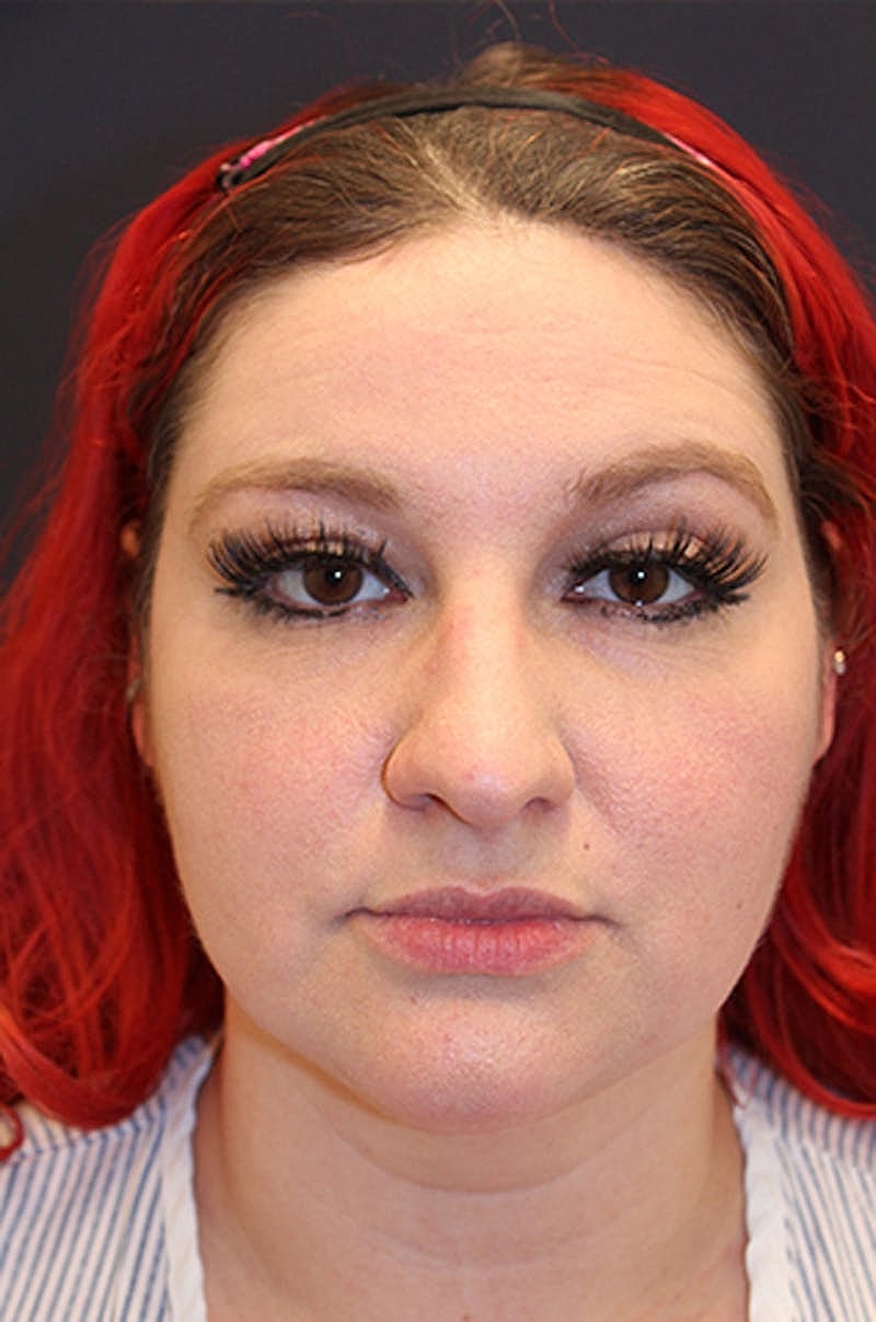 Neck Liposuction Before & After