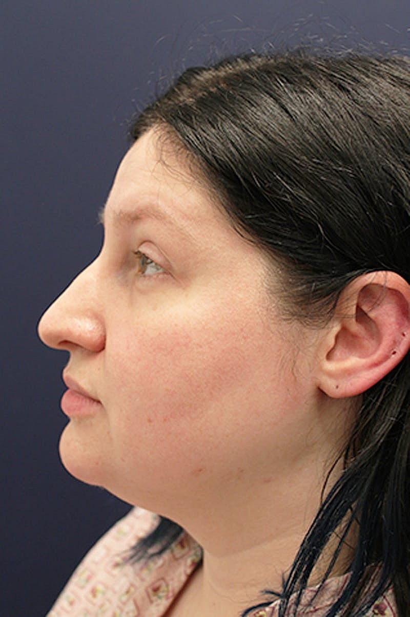Neck Liposuction Before & After