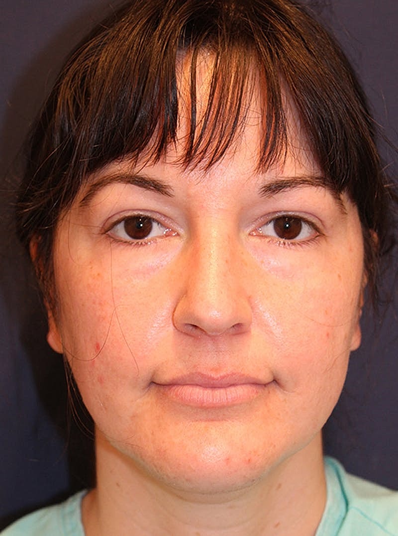 Neck Liposuction Before & After