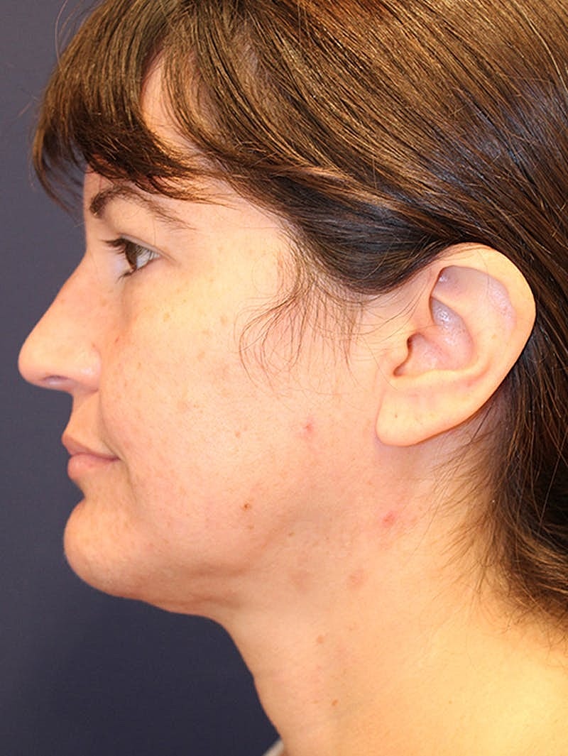 Neck Liposuction Before & After