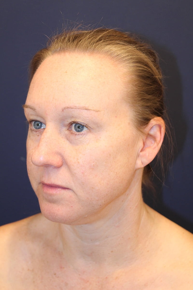 Neck Liposuction Gallery Before & After