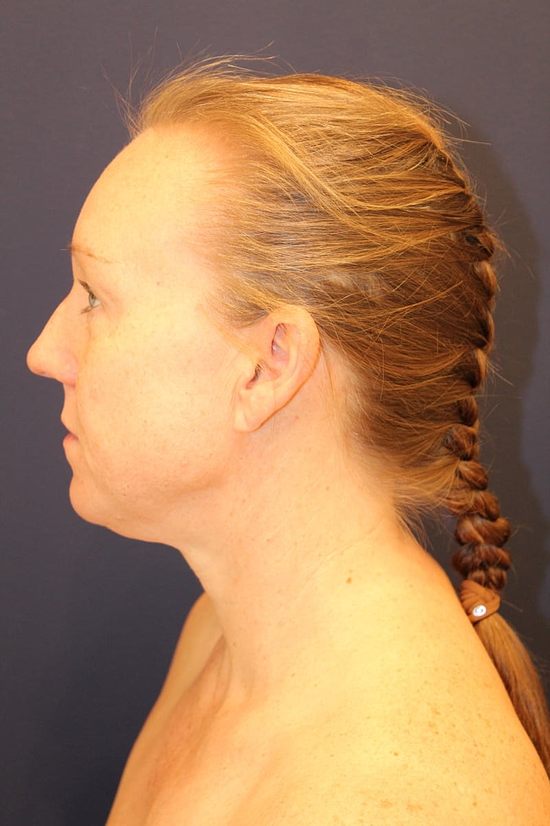 Neck Liposuction Gallery Before & After