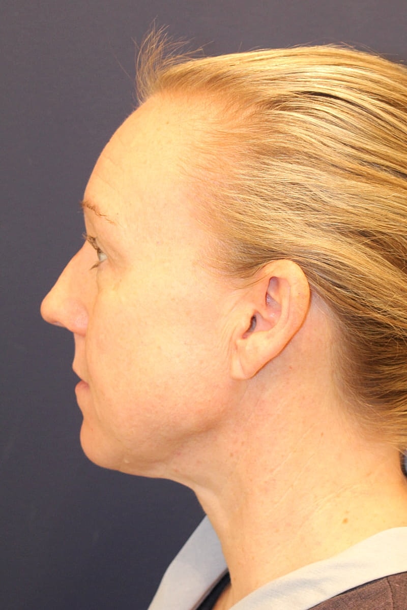 Neck Liposuction Gallery Before & After