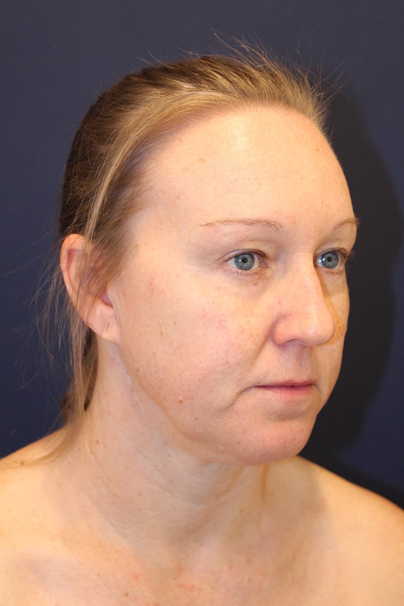 Neck Liposuction Gallery Before & After