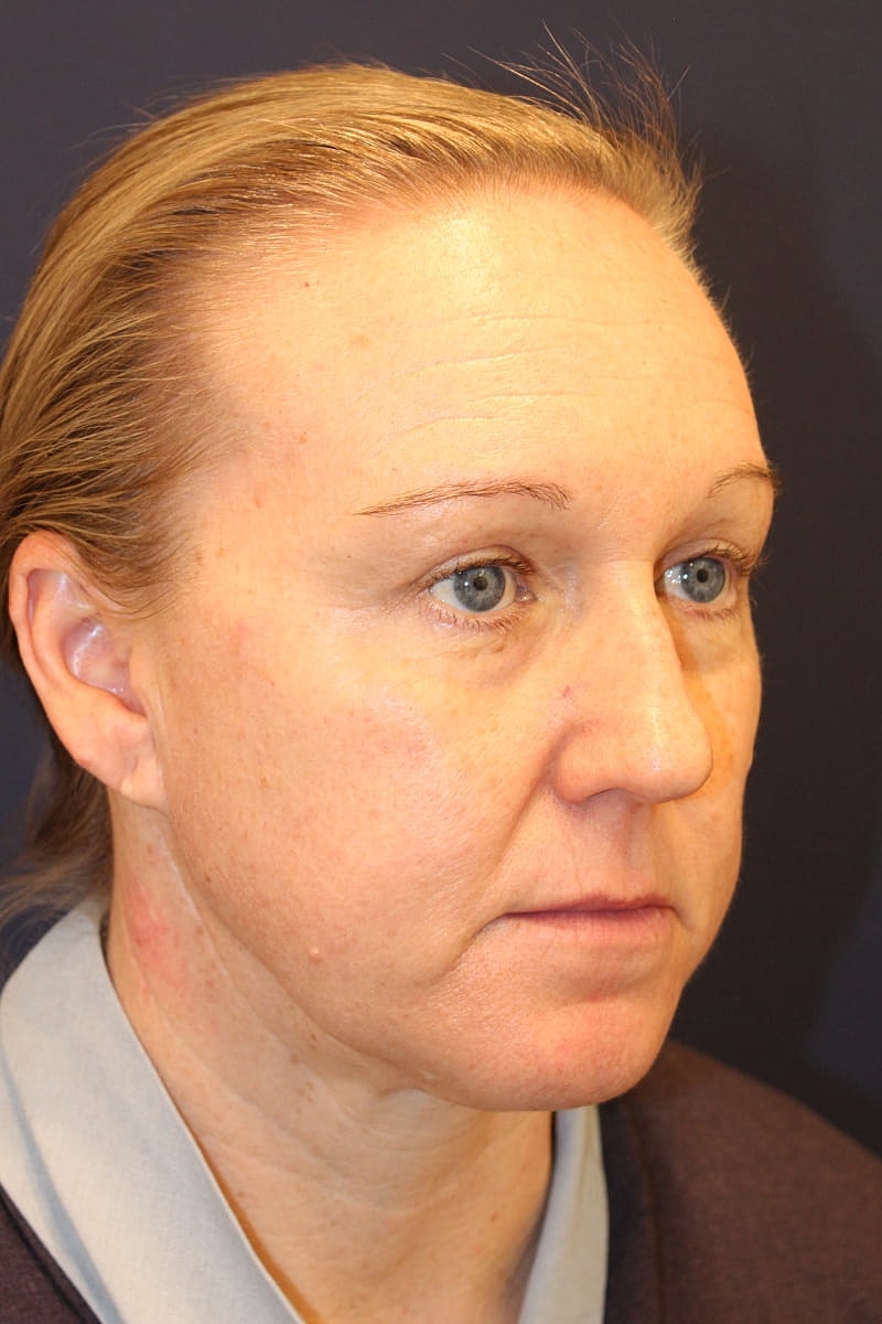 Neck Liposuction Gallery Before & After