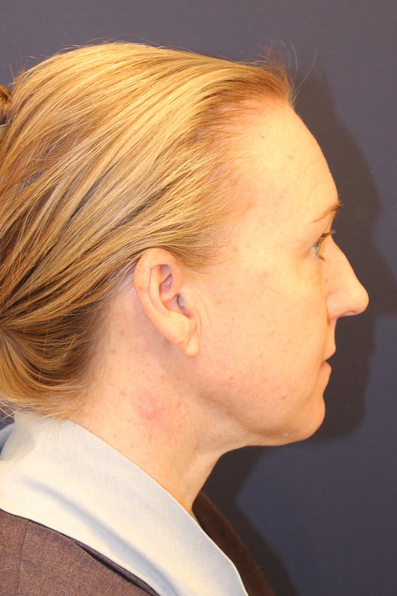 Neck Liposuction Gallery Before & After