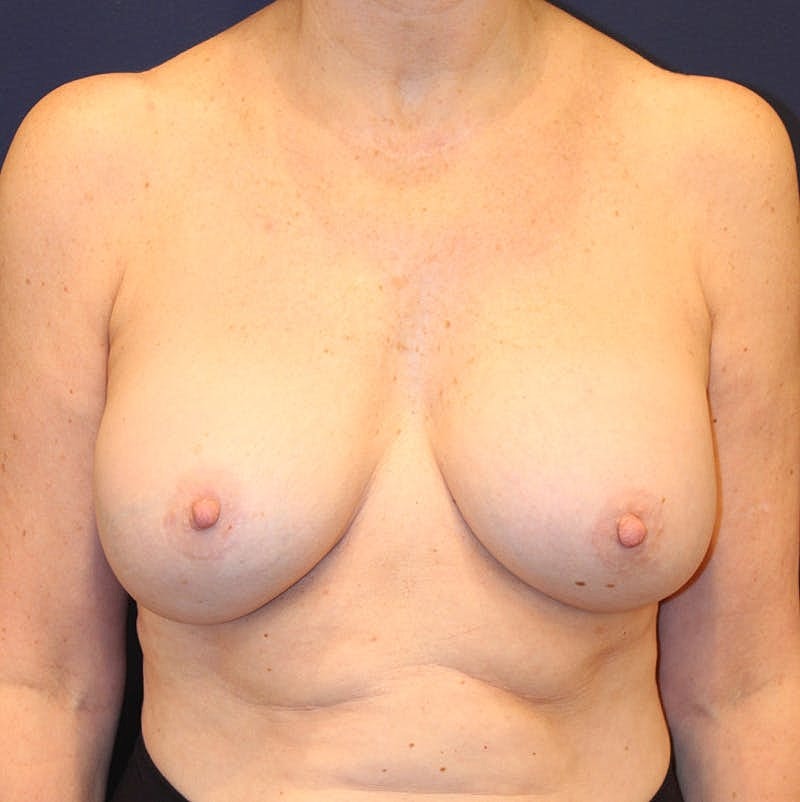 Breast Implant Revision Before & After