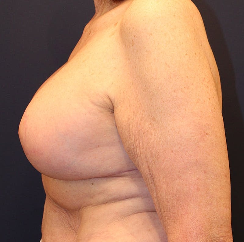 Breast Implant Revision Before & After